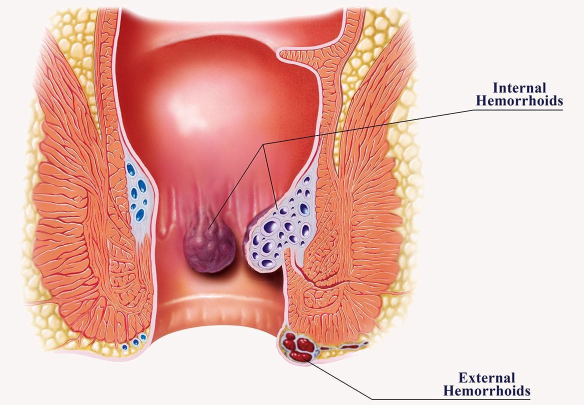 Hemorrhoids treatment in ariyakudi